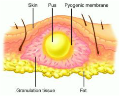 a thick yellowish or greenish opaque liquid produced in infected tissue, consisting of dead white blood cells and bacteria with tissue debris and serum.
